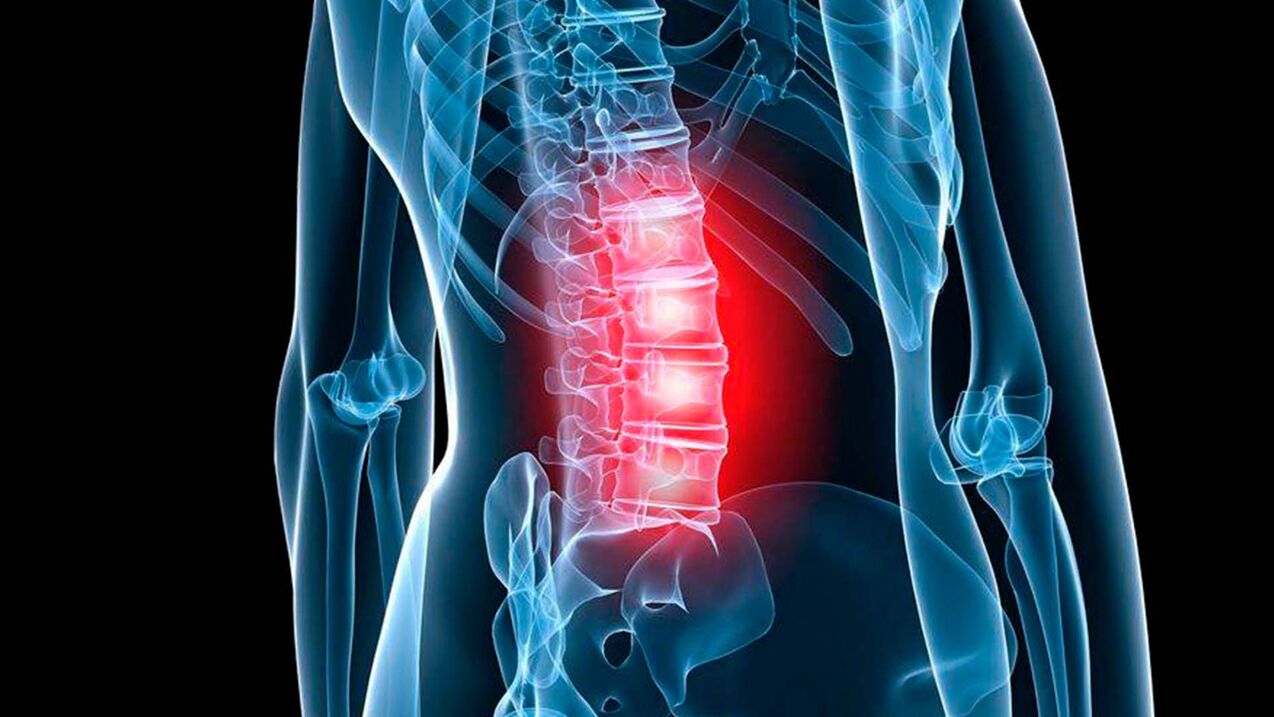 Sintomi dell'osteocondrosi lombare