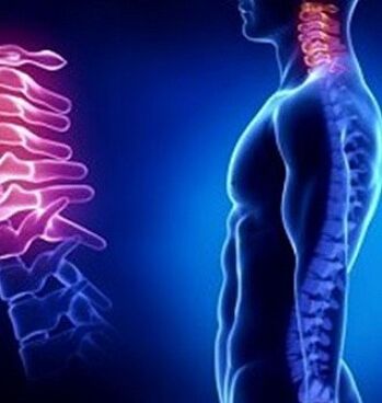 L'osteocondrosi cervicale può essere causata da lesioni al collo